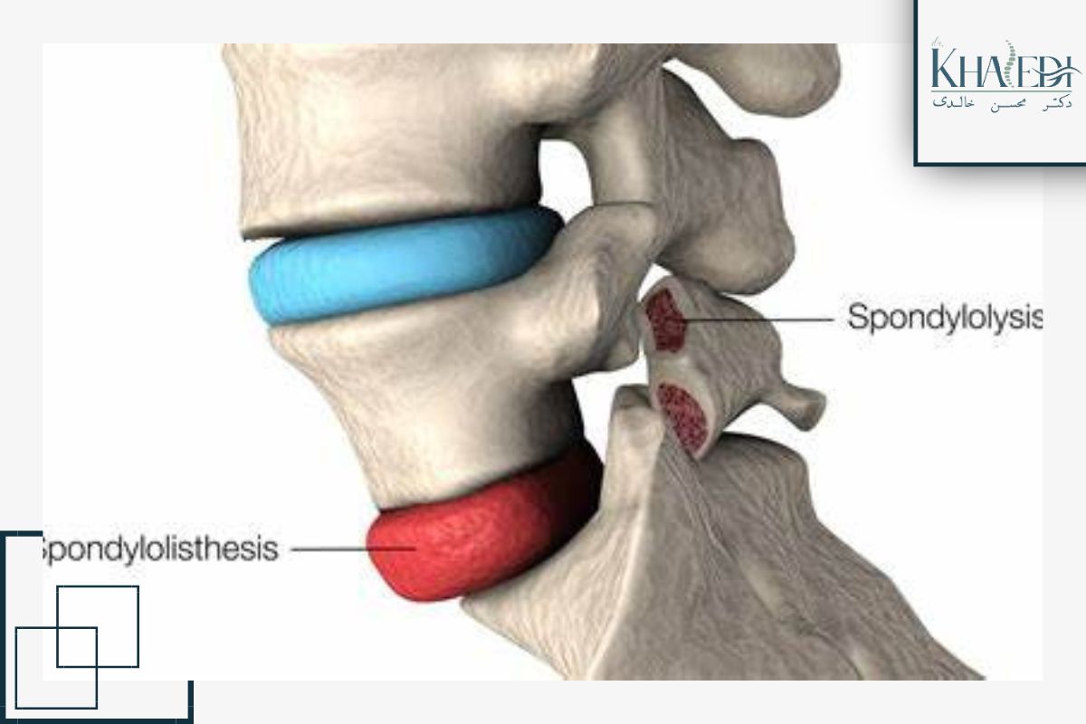 لغزش مهره‌های کمری (اسپوندیلولیستزیس)؛ علل و علائم شایع